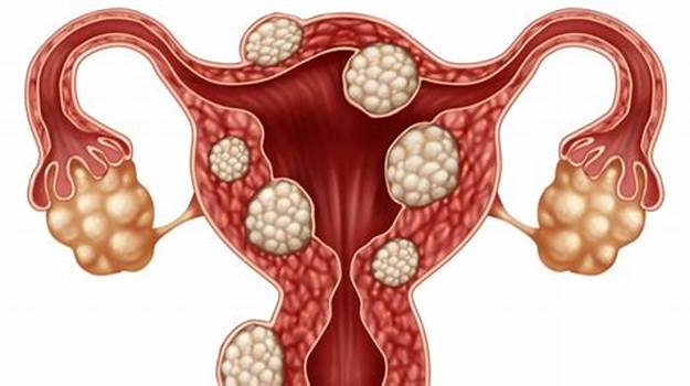 Fibroid (Uterine fibroid)